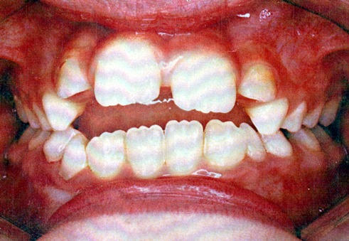 Thumb sucking teeth picture 1